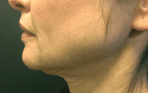 SOLTA_THERMAGE_HCP_BROCHURE_2025_05_12-32