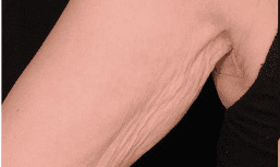 SOLTA_THERMAGE_HCP_BROCHURE_2025_05_12-36