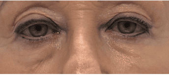 SOLTA_THERMAGE_HCP_BROCHURE_2025_05_12-43