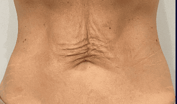 SOLTA_THERMAGE_HCP_BROCHURE_2025_05_12-44