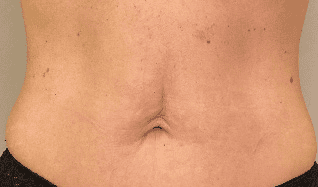 SOLTA_THERMAGE_HCP_BROCHURE_2025_05_12-47